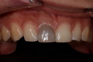 Dent noircie avant traitement