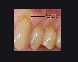 La récession gingivale… ou déchaussement des dents